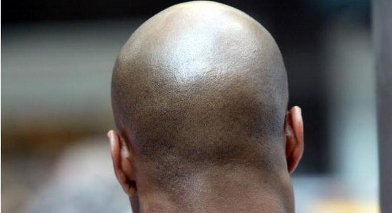12 other factors than heredity that might cause baldness